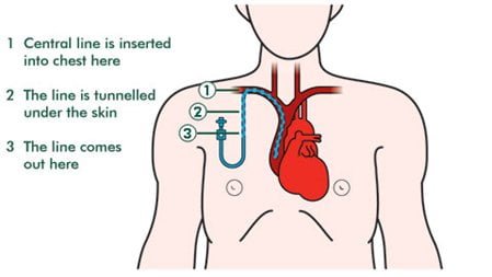 What-is-hickman-line What-is-hickman-line